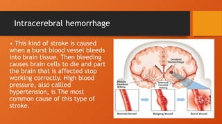 Presentation of stroke by Dr.shagnawaz (pt) | PPTX