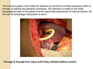 The trauma surgeon must make the decision to convert to a limited procedure within 5
minutes of starting the operative procedure. This decision is made on the initial
physiological state of the patient and the rapid initial assessment of internal injuries. Do
not wait for physiologic exhaustion to set in.
Through & thourgh liver injury with Foley catheter balloon control
 