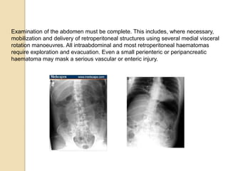 Examination of the abdomen must be complete. This includes, where necessary,
mobilization and delivery of retroperitoneal structures using several medial visceral
rotation manoeuvres. All intraabdominal and most retroperitoneal haematomas
require exploration and evacuation. Even a small perienteric or peripancreatic
haematoma may mask a serious vascular or enteric injury.
 