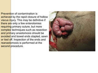 Prevention of contamination is
achieved by the rapid closure of hollow
viscus injury. This may be definitive if
there are only a few enterotomies
requiring primary suture, but more
complex techniques such as resection
and primary anastomosis should be
avoided and bowel ends stapled, sewn
or tied off. Inspection of the ends and
reanastomosis is performed at the
second procedure.
 