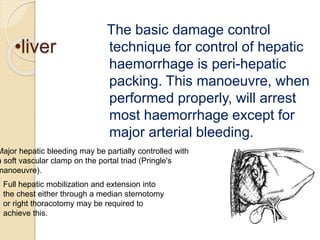 •liver
The basic damage control
technique for control of hepatic
haemorrhage is peri-hepatic
packing. This manoeuvre, when
performed properly, will arrest
most haemorrhage except for
major arterial bleeding.
Major hepatic bleeding may be partially controlled with
a soft vascular clamp on the portal triad (Pringle's
manoeuvre).
Full hepatic mobilization and extension into
the chest either through a median sternotomy
or right thoracotomy may be required to
achieve this.
 