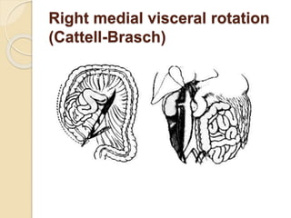 Right medial visceral rotation
(Cattell-Brasch)
 