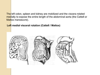 The left colon, spleen and kidney are mobilized and the viscera rotated
medially to expose the entire length of the abdominal aorta (the Cattell or
Mattox manoeuvre).
Left medial visceral rotation (Cattell / Mattox)
 