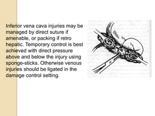Inferior vena cava injuries may be
managed by direct suture if
amenable, or packing if retro
hepatic. Temporary control is best
achieved with direct pressure
above and below the injury using
sponge-sticks. Otherwise venous
injuries should be ligated in the
damage control setting.
 