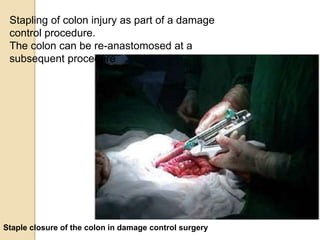 Staple closure of the colon in damage control surgery
Stapling of colon injury as part of a damage
control procedure.
The colon can be re-anastomosed at a
subsequent procedure
 