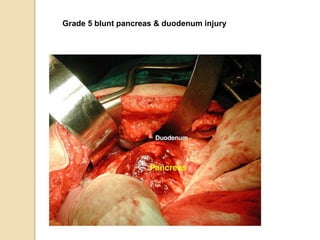 Grade 5 blunt pancreas & duodenum injury
 