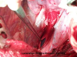 Laceration to intra-thoracic trachea
 