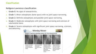 Callawrence Classification PRESENTATION ON ACUTE AND OVERUSE INJURIES OF HIP.pptx