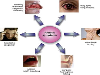 Presentation on allergic rhinitis.pptx