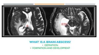 PRESENTATION ON BRAIN ABCESS AND ITS SUMMARIZATION | PDF