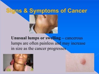 Unusual lumps or swelling – cancerous
lumps are often painless and may increase
in size as the cancer progresses
 