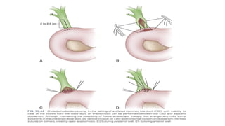 Choledocholithiasis Classification Presentation on choledocholithiasis (1) (1).pptx