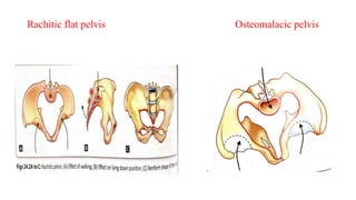 Presentation on contracted pelvis | PPTX