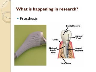 What is happening in research?
 Prosthesis
 