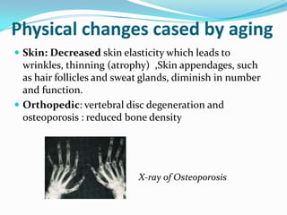 Physical changes cased by agingSkin: Decreased skin elasticity which leads to wrinkles, thinning (atrophy)  ,Skin appendages, such as hair follicles and sweat glands, diminish in number and function.Orthopedic: vertebral disc degeneration and osteoporosis : reduced bone density                                                   X-ray of Osteoporosis