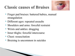  Foto zu Presentation on examination of bruise.pptx 