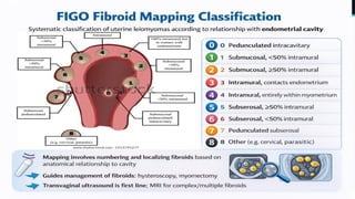 Myome Classification Etiology, clinical presentation, diagnosis and management of Uterine ...