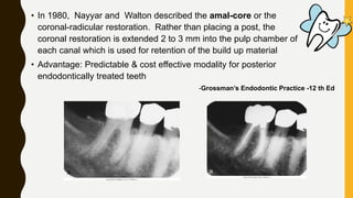 • In 1980, Nayyar and Walton described the amal-core or the
coronal-radicular restoration. Rather than placing a post, the
coronal restoration is extended 2 to 3 mm into the pulp chamber of
each canal which is used for retention of the build up material
• Advantage: Predictable & cost effective modality for posterior
endodontically treated teeth
-Grossman’s Endodontic Practice -12 th Ed
 