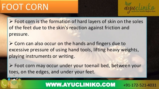 home remedies for foot corn