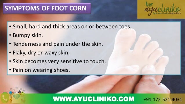 corn in feet ayurvedic treatment