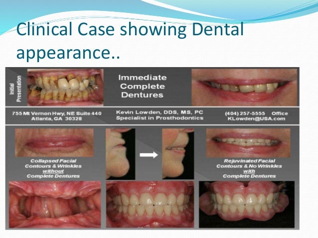 Immediate denture Immediate denture