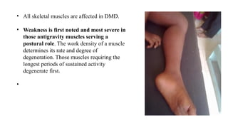 • All skeletal muscles are affected in DMD.
• Weakness is first noted and most severe in
those antigravity muscles serving a
postural role. The work density of a muscle
determines its rate and degree of
degeneration. Those muscles requiring the
longest periods of sustained activity
degenerate first.
•
 