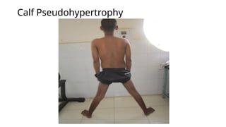 Calf Pseudohypertrophy
 