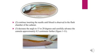  (2) continue inserting the needle until blood is observed in the flash
chamber of the catheter.
 (3) decrease the angle to 15 to 20 degrees and carefully advance the
cannula approximately 0.5 centimeter farther (figure 1-11).
 