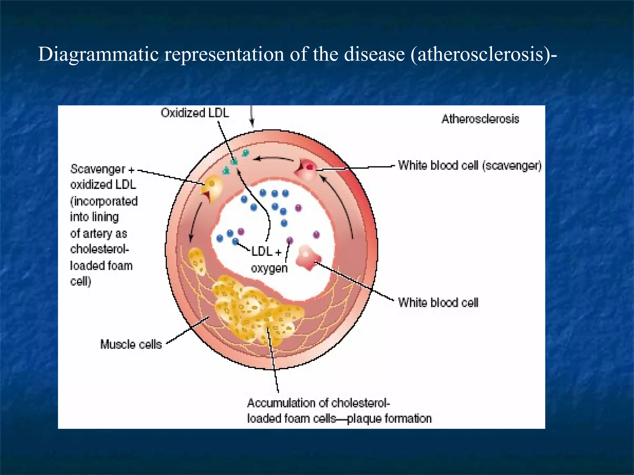 Diagrammatic representation of the disease (atherosclerosis)- 