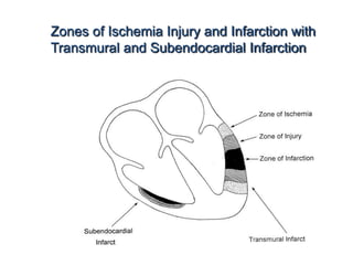 Zones of Ischemia Injury and Infarction with
Transmural and Subendocardial Infarction
 