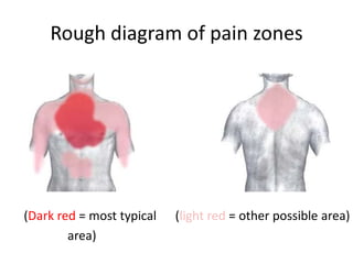 Rough diagram of pain zones




(Dark red = most typical   (light red = other possible area)
        area)
 