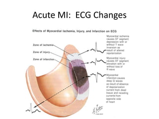 Acute MI: ECG Changes
 