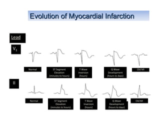 Evolution of Myocardial Infarction

Lead

V1



       Normal      ST Segment          T Wave            Q Wave           Old MI
                    Elevation         Inversion        Development
                (minutes to hours)     (hours)        (hours to days)

II


       Normal       ST Segment             T Wave         Q Wave         Old MI
                     Elevation            Inversion     Development
                 (minutes to hours)        (hours)     (hours to days)
 