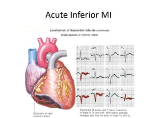 Acute Inferior MI
 