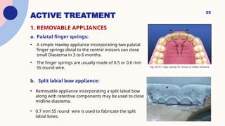 Presentation on Midline Diastema correction.pptx