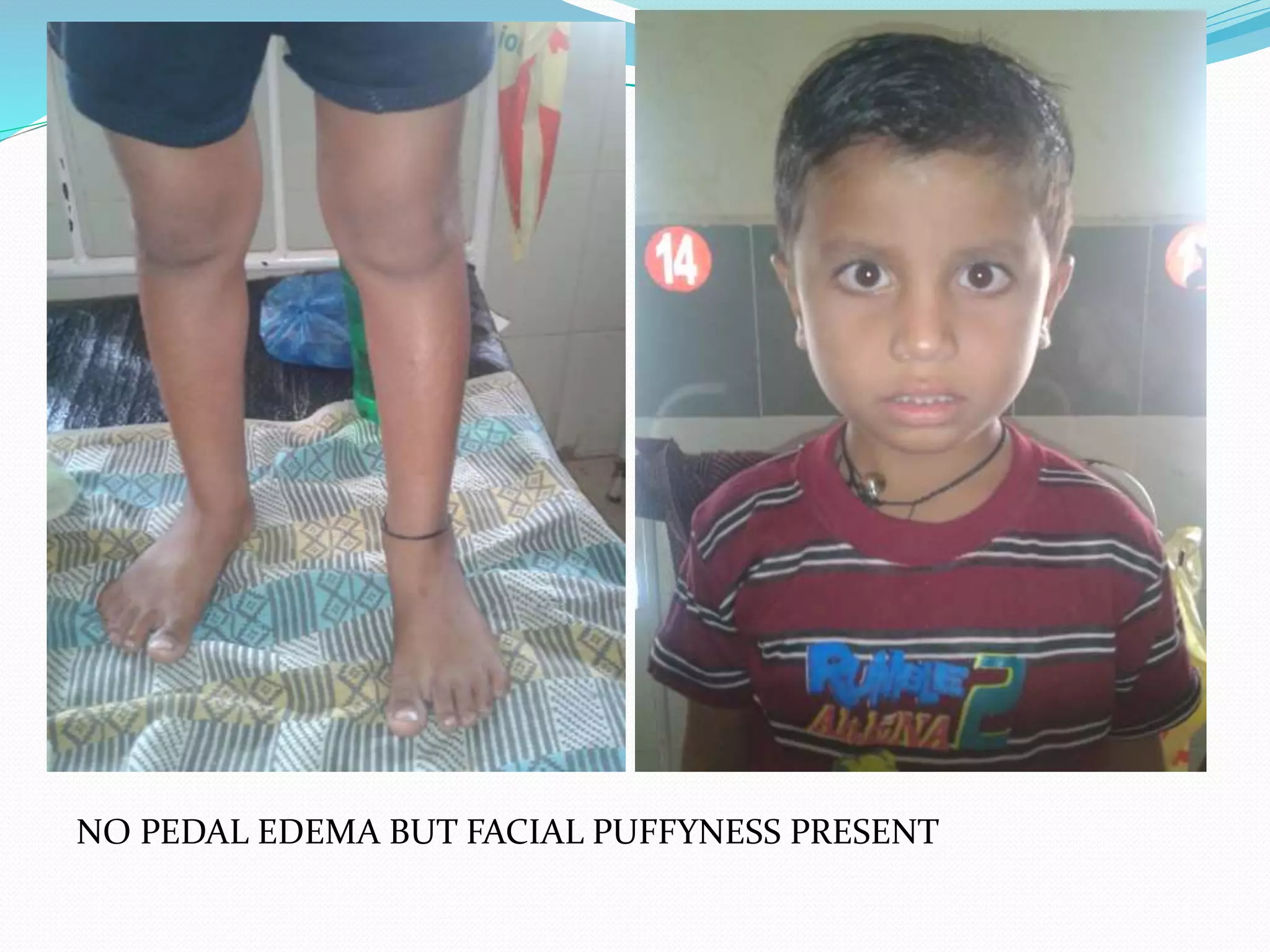 NO PEDAL EDEMA BUT FACIAL PUFFYNESS PRESENT
 