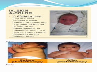Plethora In Newborn Plethora In Newborn