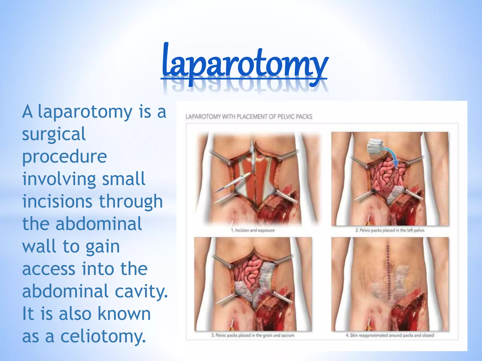 A laparotomy is a
surgical
procedure
involving small
incisions through
the abdominal
wall to gain
access into the
abdominal cavity.
It is also known
as a celiotomy.
laparotomy
 