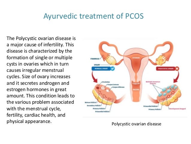 Ayurvedic treatment of PCOS
The Polycystic ovarian disease is
a major cause of infertility. This
disease is characterized by the
formation of single or multiple
cysts in ovaries which in turn
causes irregular menstrual
cycles. Size of ovary increases
and it secretes androgen and
estrogen hormones in great
amount. This condition leads to
the various problem associated
with the menstrual cycle,
fertility, cardiac health, and
physical appearance. Polycystic ovarian disease
 