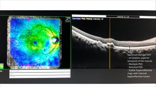 Presentation on Polypoidal Choroidal Vasculopathy.pdf