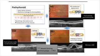Presentation on Polypoidal Choroidal Vasculopathy.pdf