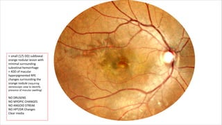Presentation on Polypoidal Choroidal Vasculopathy.pdf