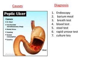 Diagnosis
1. Endoscopy
2. barium meal
3. breath test
4. blood test
5. stool test
6. rapid urease test
7. culture test
Causes
 
