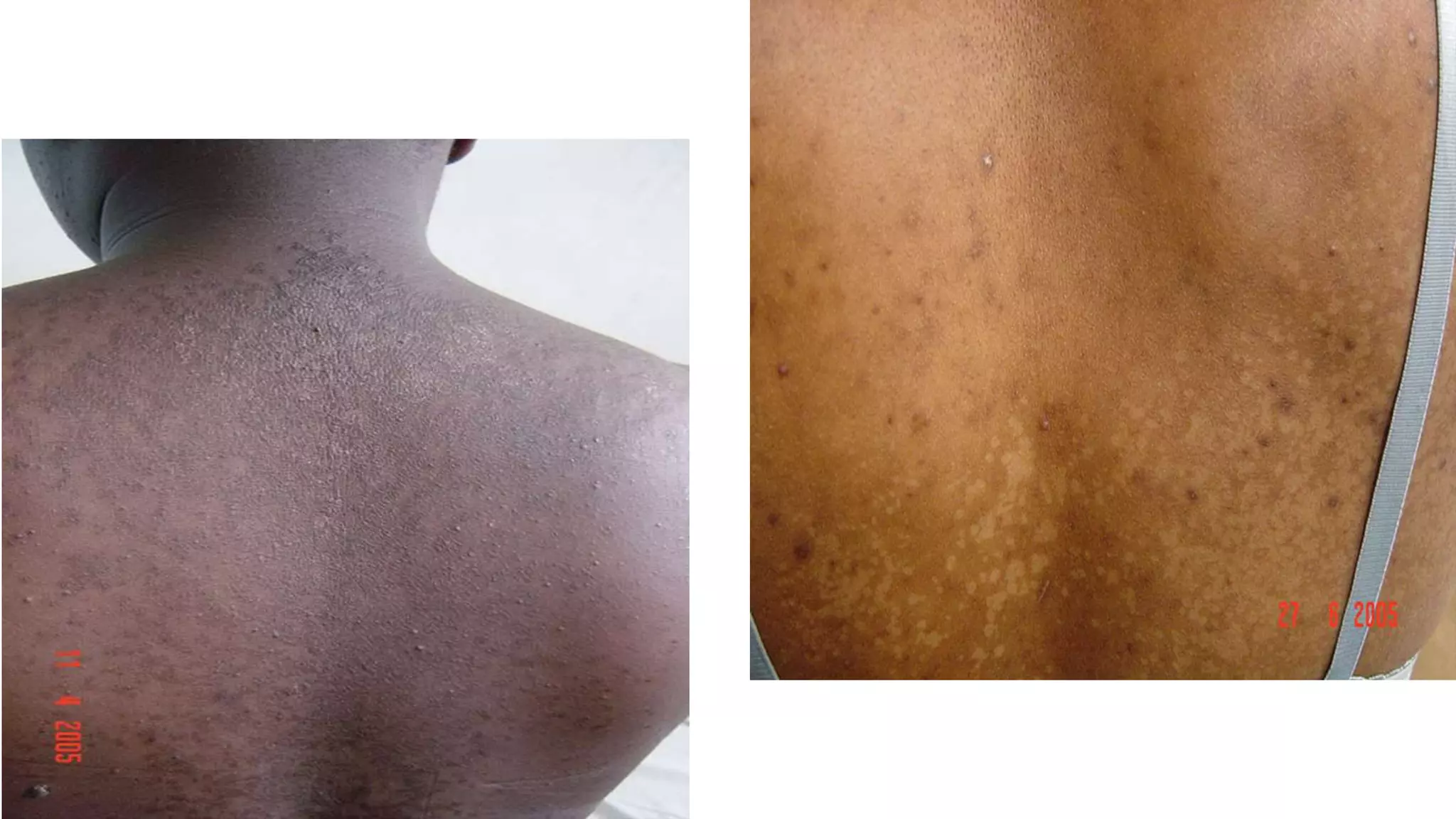 Presentation on Pityriasis Versicolor .pptx