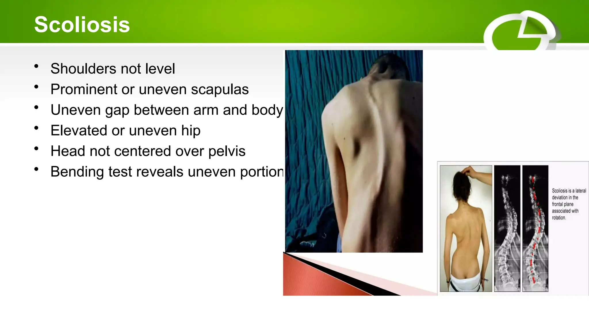 Scoliosis
• Shoulders not level
• Prominent or uneven scapulas
• Uneven gap between arm and body
• Elevated or uneven hip
• Head not centered over pelvis
• Bending test reveals uneven portions of back
 