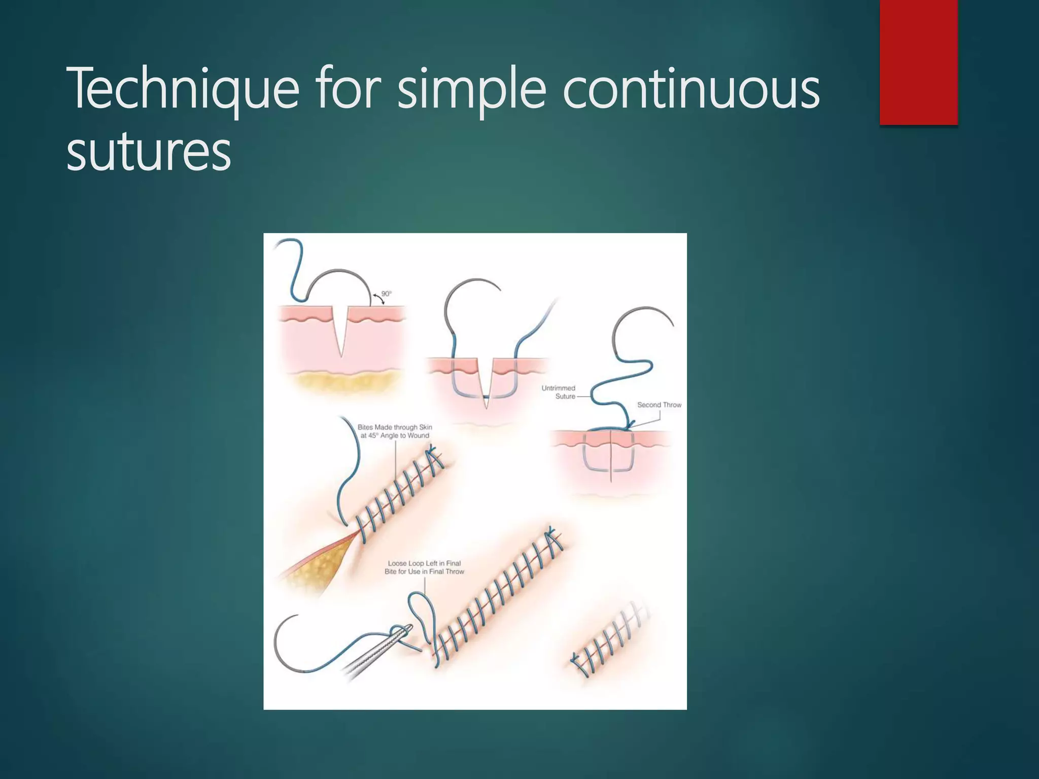 Suture Materials and Suturing Techniques | PPTX