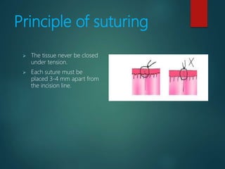 Principle of suturing
 The tissue never be closed
under tension.
 Each suture must be
placed 3-4 mm apart from
the incision line.
 