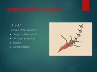 Interrupted sutures
 Use:
closure of wound after –
 Single tooth extraction.
 3rd molar extraction.
 Biopsy.
 Dental implant.
 