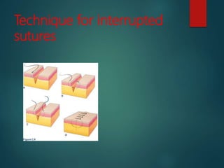 Technique for interrupted
sutures
 