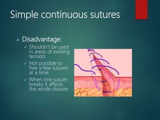 Simple continuous sutures
 Disadvantage:
 Shouldn’t be used
in areas of existing
tension.
 Not possible to
free a few sutures
at a time.
 When one suture
breaks it affects
the whole closure.
 